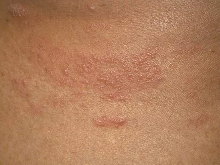Herpes pe corpul cauzele, simptomele și tratamentul (aspectul) Herpes pe corpul cauzele, simptomele și tratamentul