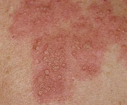 Herpes pe corpul cauzele, simptomele și tratamentul (motive) Herpes pe corpul cauzele, simptomele și tratamentul