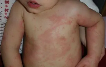eritem infecțioase la copii - 30 de fotografii, simptome și tratament, site-ul medical