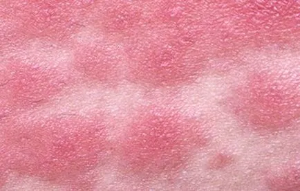 eritem infecțioase la copii - 30 de fotografii, simptome și tratament, site-ul medical