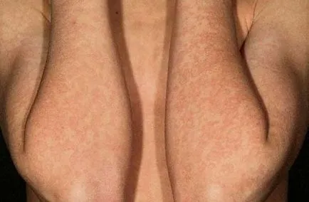 eritem infecțioase la copii - 30 de fotografii, simptome și tratament, site-ul medical