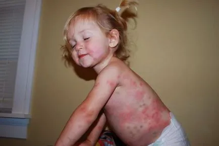 eritem infecțioase la copii - 30 de fotografii, simptome și tratament, site-ul medical