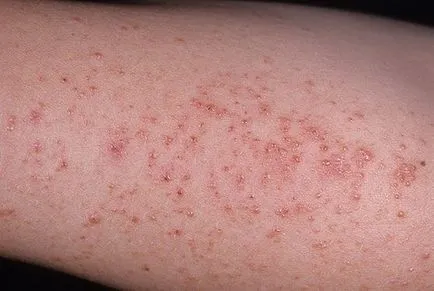 eritem infecțioase la copii - 30 de fotografii, simptome și tratament, site-ul medical