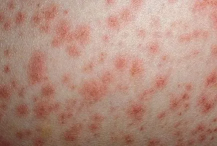 eritem infecțioase la copii - 30 de fotografii, simptome și tratament, site-ul medical
