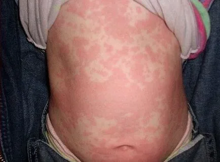 eritem infecțioase la copii - 30 de fotografii, simptome și tratament, site-ul medical