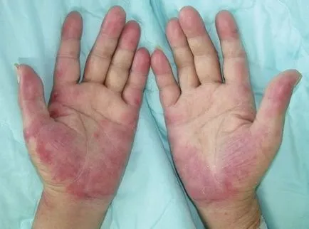 eritem infecțioase la copii - 30 de fotografii, simptome și tratament, site-ul medical