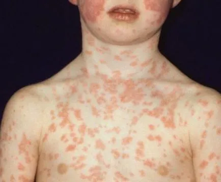 eritem infecțioase la copii - 30 de fotografii, simptome și tratament, site-ul medical