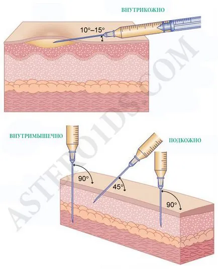 injectii cu steroizi, cum să facă injecții, în cazul în care steroizi junghi, steroizi cum ar fi înjunghiere
