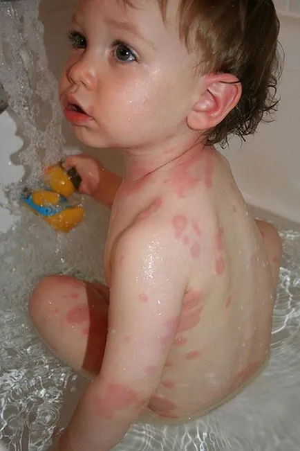eritem infecțioase la copii - 30 de fotografii, simptome și tratament, site-ul medical