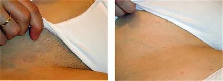Și Ipl RF epilarea - caracteristici de eficiență tehnică (de îndepărtare a părului) îndepărtarea părului și RF IPL - tehnica, eficiență, în special