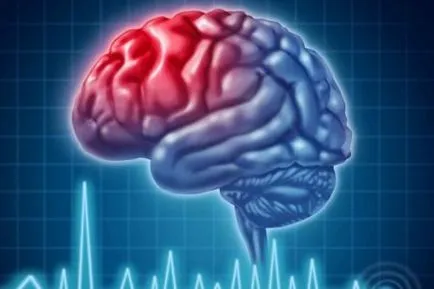 ischemie cerebrală ce este, simptome și efecte de tratament, măsură, cât de mulți trăiesc