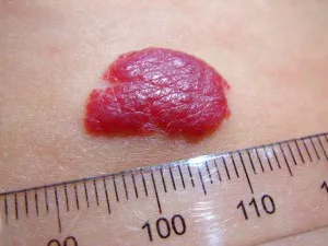 Cum de a trata și de a elimina cu laser hemangiom, propranolol, gel timolol, arutimolom, anaprilinom