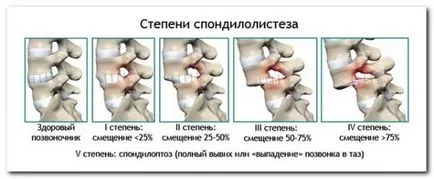 Cum de a trata prejudecată vertebre lombare (vertebre) Cum de a trata vertebre lombare deplasare