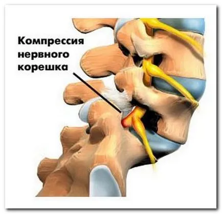 Cum de a trata prejudecată vertebre lombare (lombare) Cum de a trata vertebre lombare deplasare