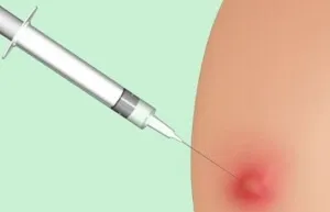 Cum de a face o lovitură în fesă, injecții intramusculare la domiciliu, tehnologie