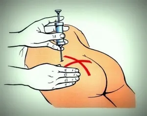 Cum de a face o lovitură în fesă, injecții intramusculare la domiciliu, tehnologie