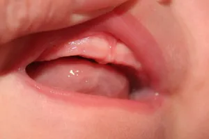 Cum se taie dinții superiori la sugari cat timp dureaza (lung) Cum să taie dinții de sus la sugari cat timp dureaza