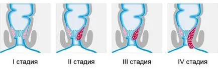 determină în mod independent, hemoroizi la domiciliu - de unde știi această boală special,