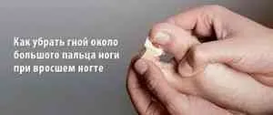 Cum de a elimina puroiul din rana - atunci când acasă bolnavi - Articole Directory - Sfaturi utile pentru casa