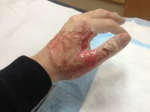Cum de a elimina o arsura pe mâna lui (arde) Cum de a elimina o arsura pe mâna lui
