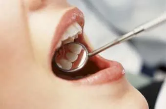 Cum de a restabili smaltul dintilor pe care le puteți face singur acasă (poate) Cum de a restabili smaltul dintilor pe care le puteți face singur acasă