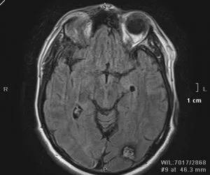 creier și măduva spinării cavernoma efecte, contraindicații, îndepărtarea