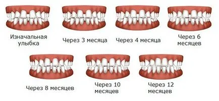 photo Capa pentru a alinia dinti, pret, recenzii (recenzii CAPAJ pentru aliniere dinți) photo Capa pentru a alinia dinti, pret, recenzii