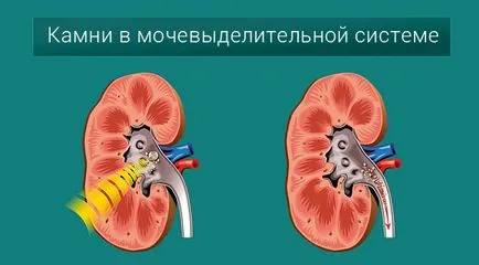 Piatra este blocat în dizolvarea metodelor ureter și zdrobire (Folk, cu laser, ultrasunete)