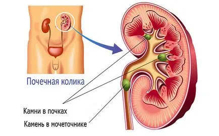 Piatra este blocat în dizolvarea metodelor ureter și zdrobire (Folk, cu laser, ultrasunete)