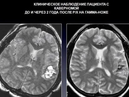 cavernoma creier simptome, consecințe