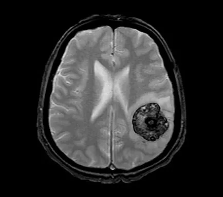 cauze, simptome, diagnostic, tratamente, efecte cavernoma creierului