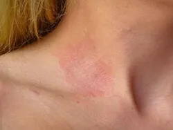dermatita de contact - tratament, simptomele, cauzele