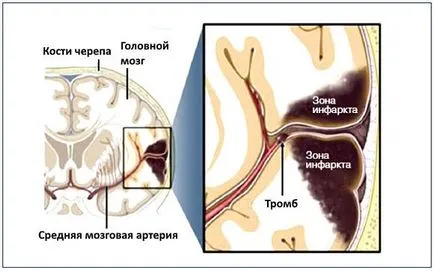 Coma după un accident vascular cerebral la vârstnici