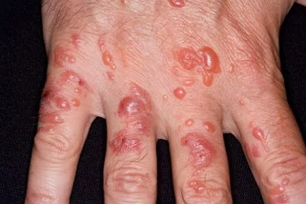 dermatita de contact - tratament, simptomele, cauzele