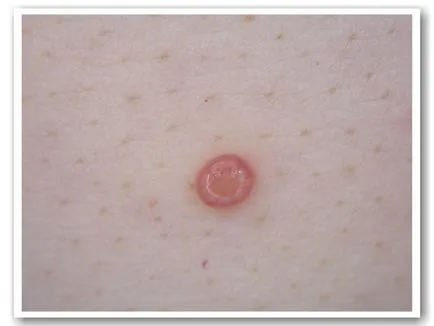 Molluscum contagiosum - îndepărtarea București