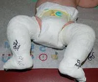 PVE - cauze, diagnostic, tratament