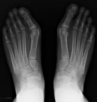 PVE - cauze, diagnostic, tratament