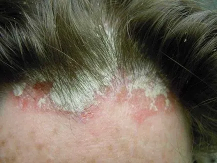 matreata Cork asupra cauzelor cap si tratamente pentru crusta la adult (matreata culoare crusta) matreata Cork asupra cauzelor cap si tratamente pentru crusta la un adult