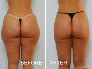 Cryolipolysis cum funcționează această metodă, utilizarea acestei proceduri în salon și la domiciliu,