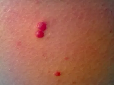 mol roșii pe cauzele corpului