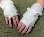 Tratamentul arsurilor la copii, cum să trateze o arsură unguent mai eficient în funcție de gradul (arsuri de gradul) Tratamentul arsurilor la copii, cum să trateze o arsură unguent mai eficient, în funcție de gradul de