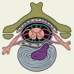 Tratamentul cu laser hernie spinal