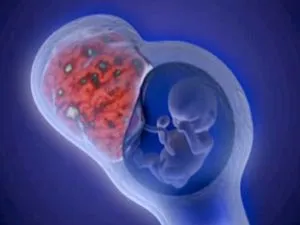 uterin tratament fibrom de dimensiuni mari (tratament) Tratamentul fibrom uterin mai mari