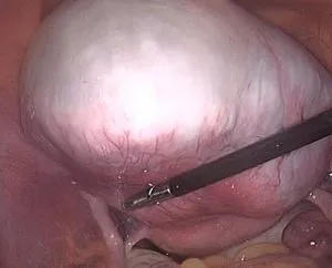 uterin tratament fibrom de dimensiuni mari (dimensiunea mare a uterului) Tratamentul fibrom uterin mai mari