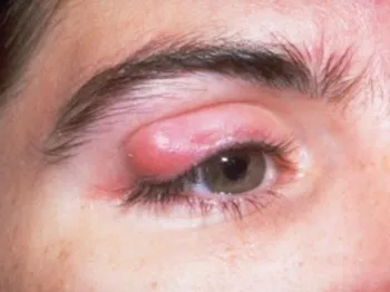 Tratamentul de remedii populare blefarită (tratament) Tratamentul de remedii populare blefarită