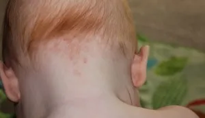 chelia pe partea din spate a capului la sugari cauze, tratament, consiliere
