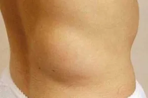Lipom privind cauzele spate decât periculoase, tratament