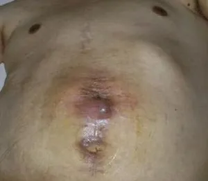 fistula ligatură imagine postoperatorie, cauze, tratament (chirurgie) fistula ligatură după o intervenție chirurgicală fotografie, cauze, tratament