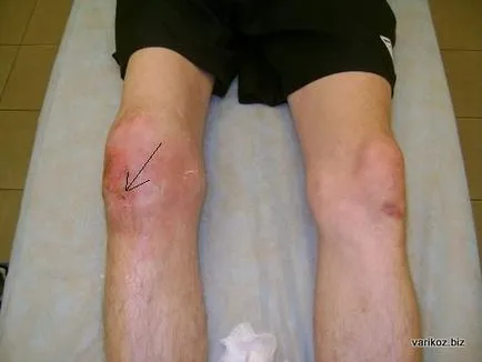 fistula ligatură