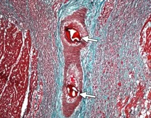 Microinfarction - simptome, semne timpurii și caracteristici ale tratamentului